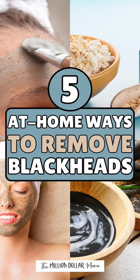 5 Ways to Remove Blackheads at Home - Safe Methods To Remove Blackheads